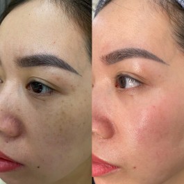 Điều trị nám, chàm, bớt, tàn nhang, đồi mồi
