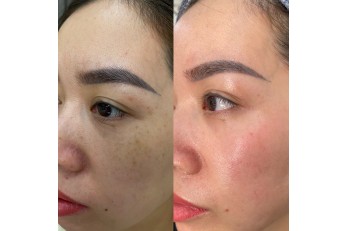 Điều trị nám, chàm, bớt, tàn nhang, đồi mồi